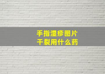 手指湿疹图片 干裂用什么药